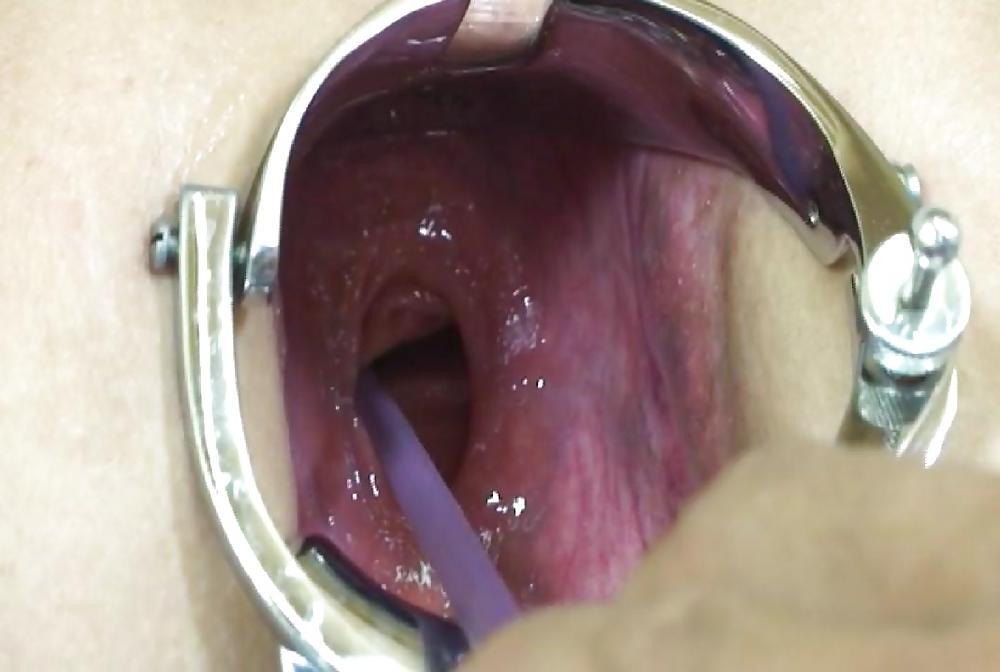 25P Gape and prolapse 2