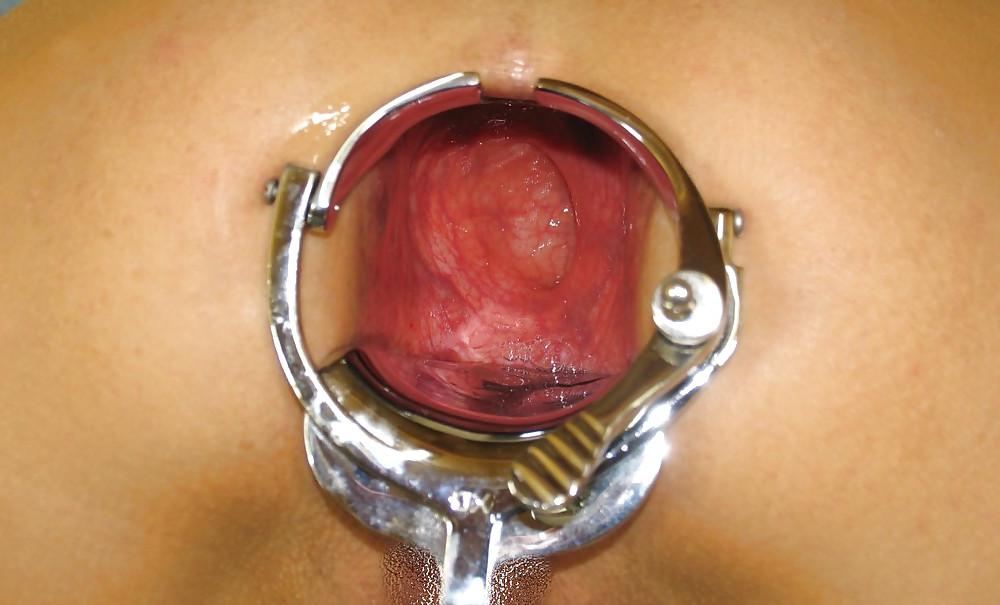25P Gape and prolapse 2