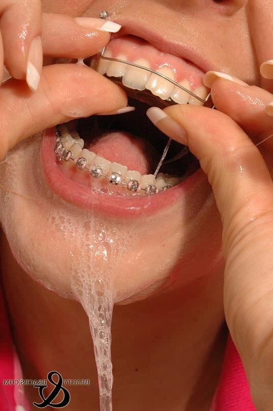 16P Babe in shiny wet metal mouth braces sloppily brushing her teeth