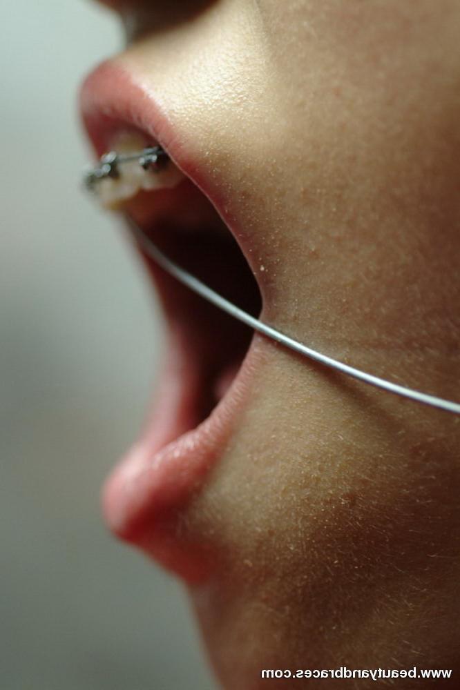 16P Nude blonde teen with braces has her head wrapped in wire