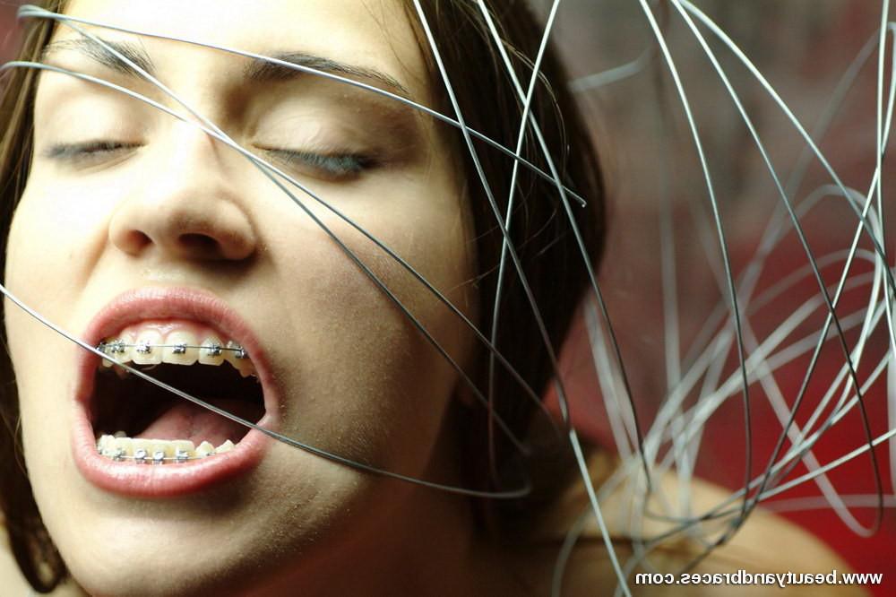 16P Nude blonde teen with braces has her head wrapped in wire