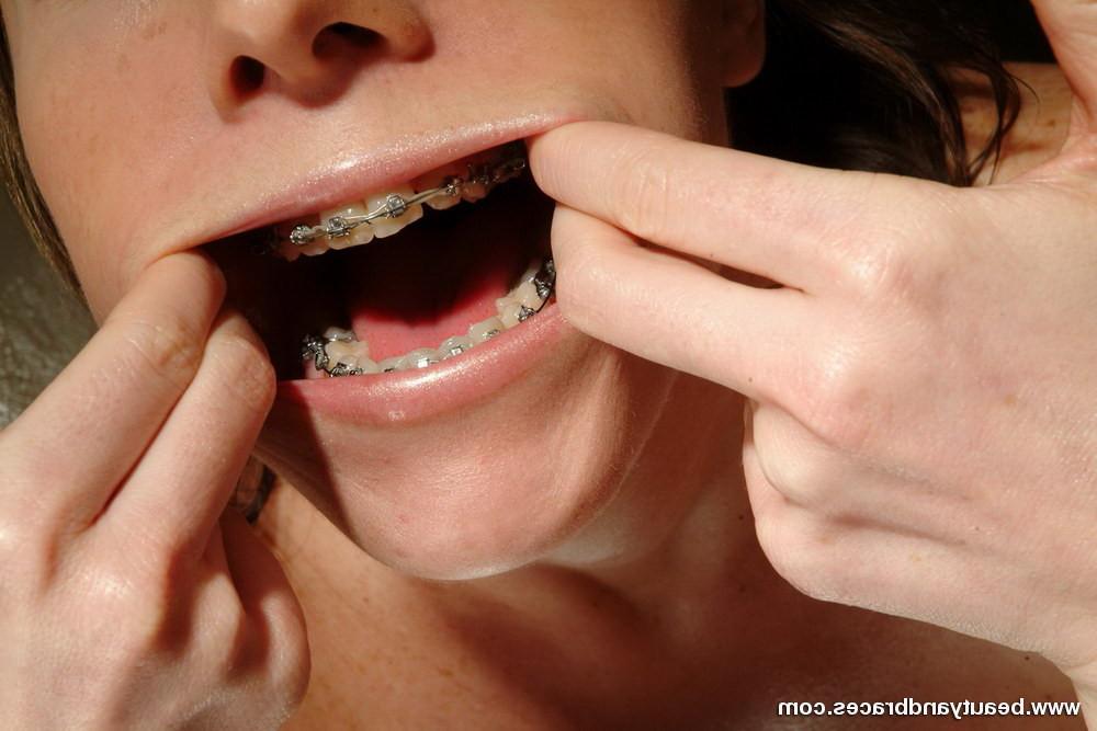 16P Busty beauty with braces poses in the buff