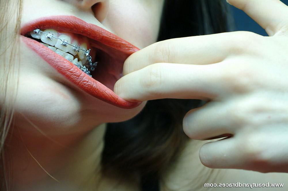 16P Cute brunette teen with braces stretches her mouth wide open