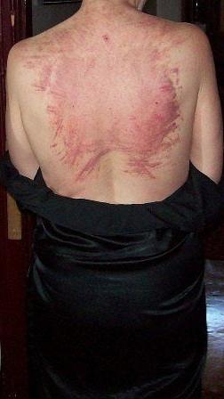 14P Whipped backs of Girls 3