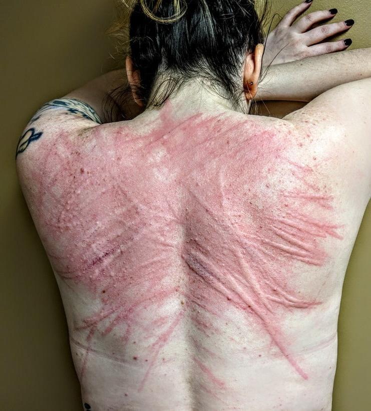 22P Whipped backs of Girls 2