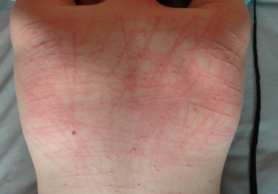 24P Whipped backs of girls