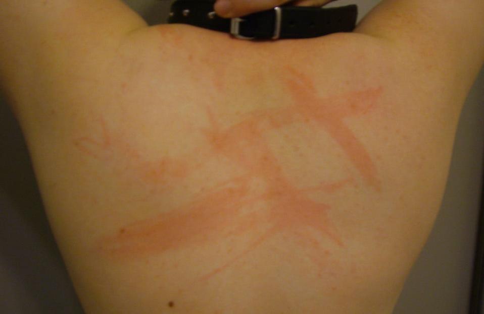 24P Whipped backs of girls