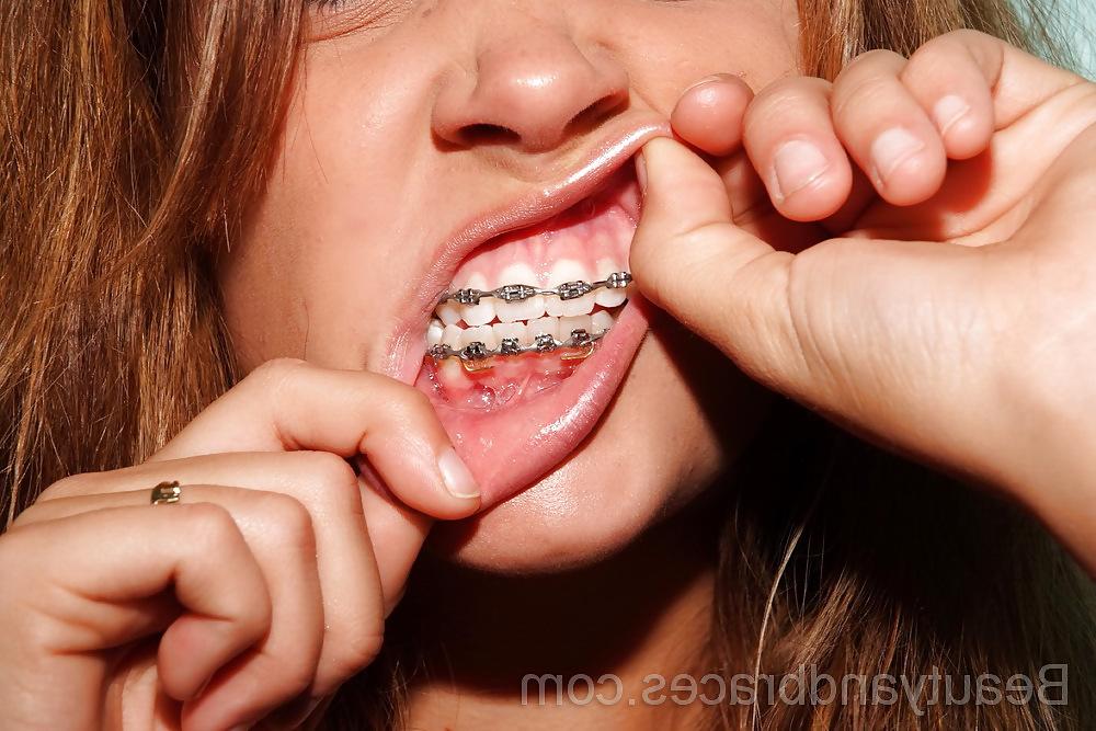 18P Beautiful teen with Braces