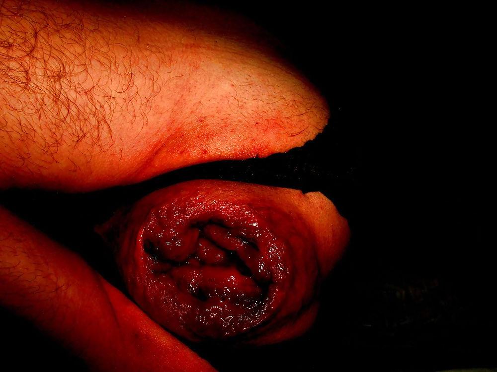 25P Extreme prolapse gape asshole by Marques