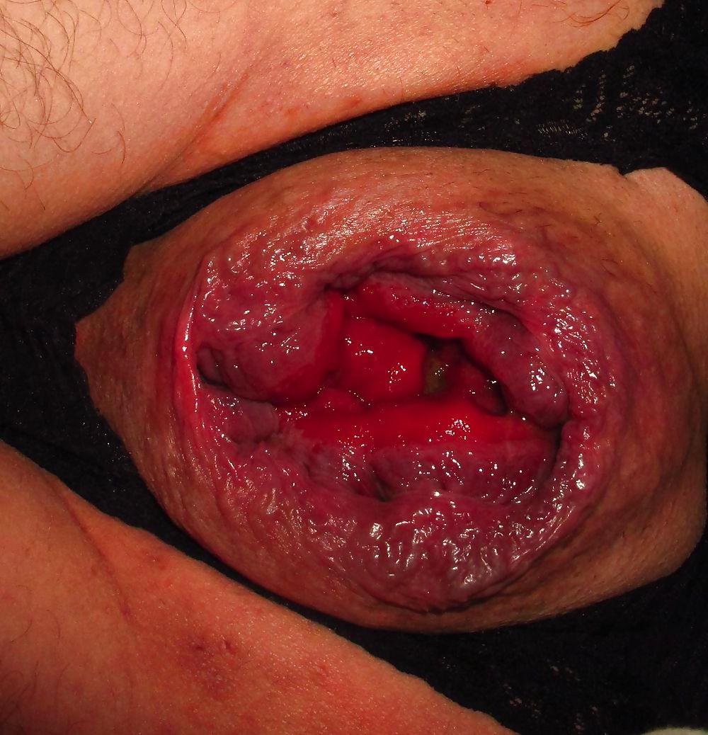 25P Extreme prolapse gape asshole by Marques