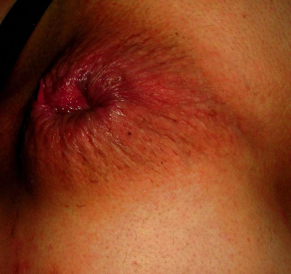 25P Extreme prolapse gape asshole by Marques
