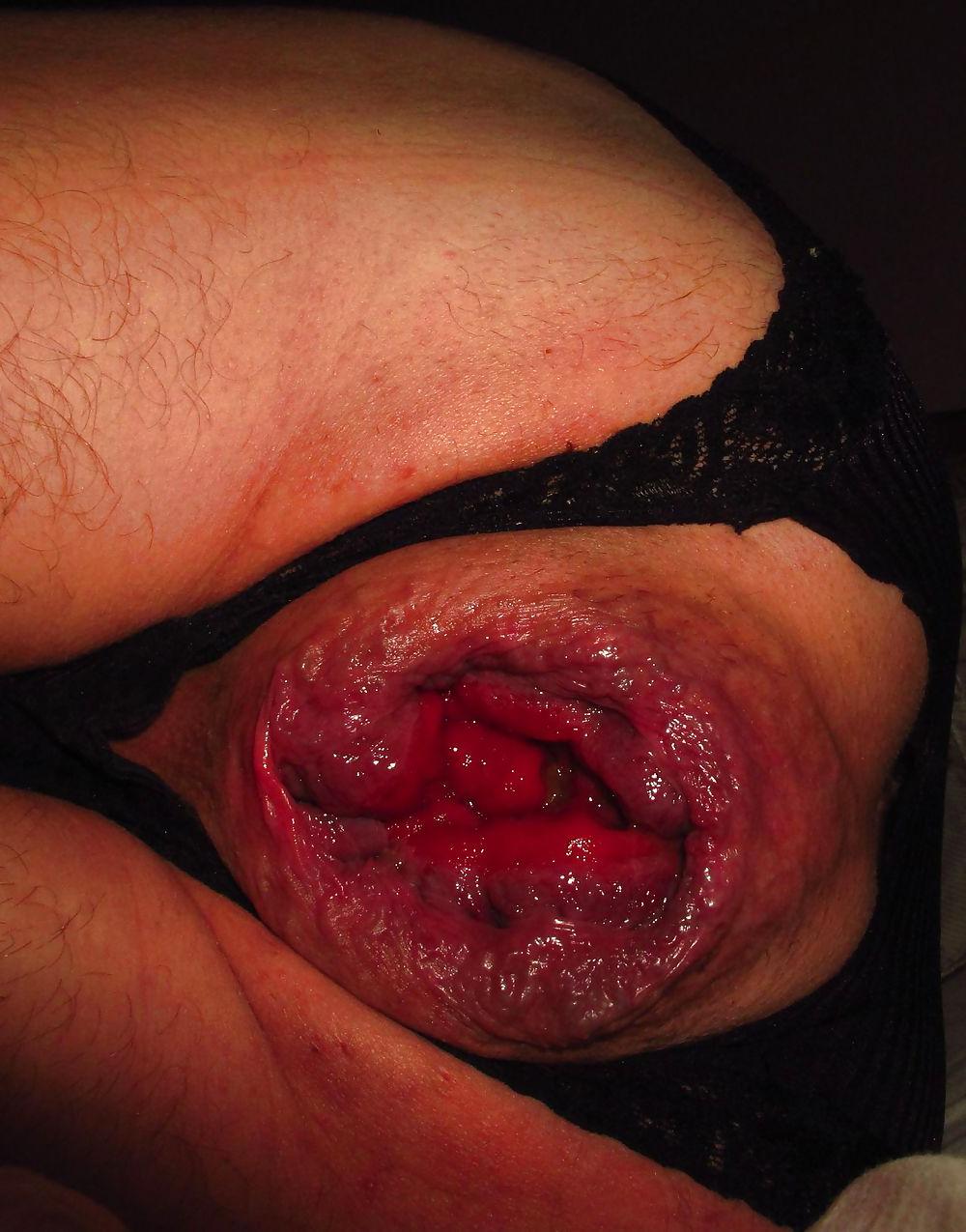 25P Extreme prolapse gape asshole by Marques