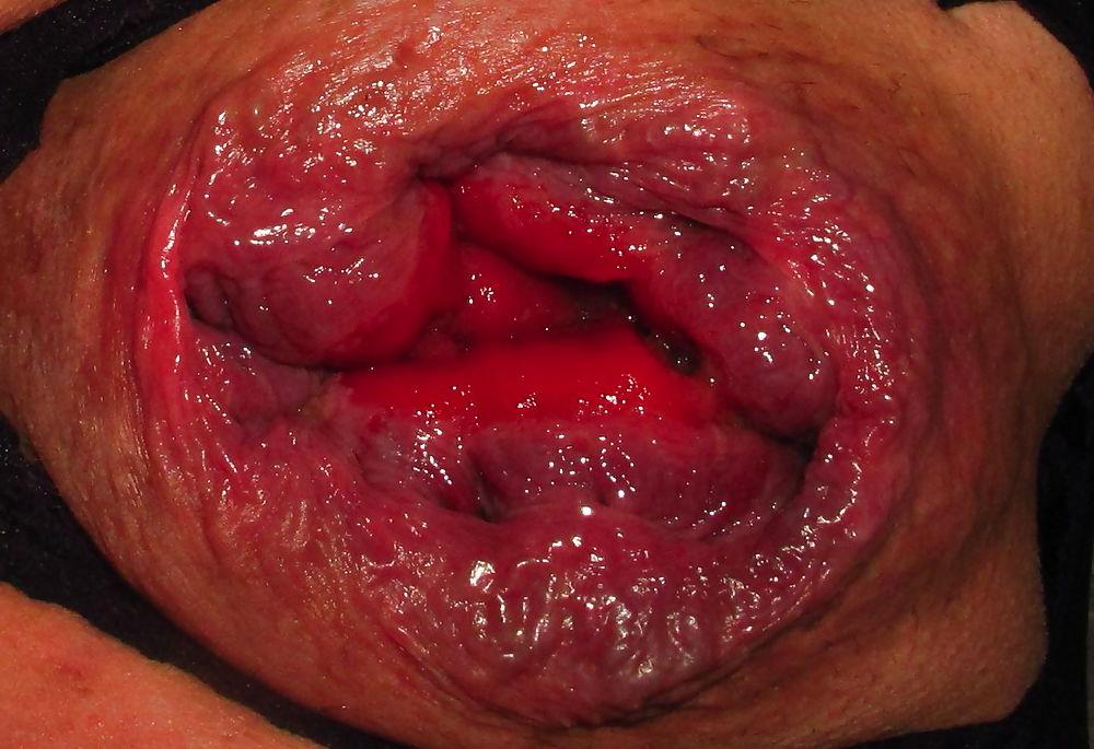 25P Extreme prolapse gape asshole by Marques