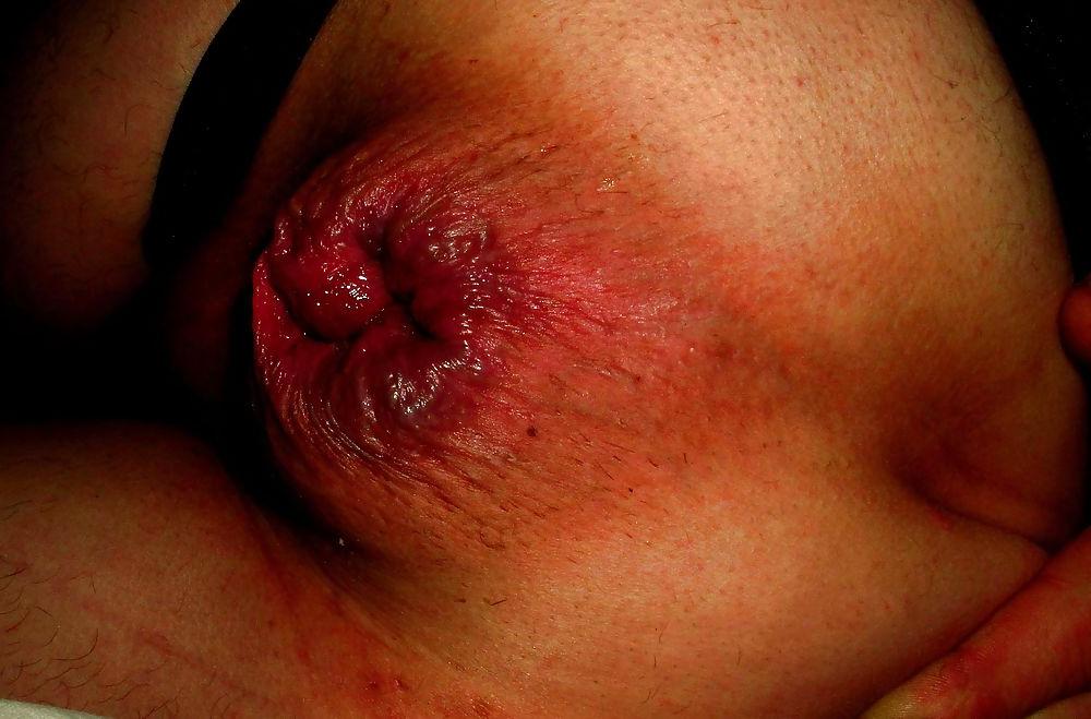 25P Extreme prolapse gape asshole by Marques