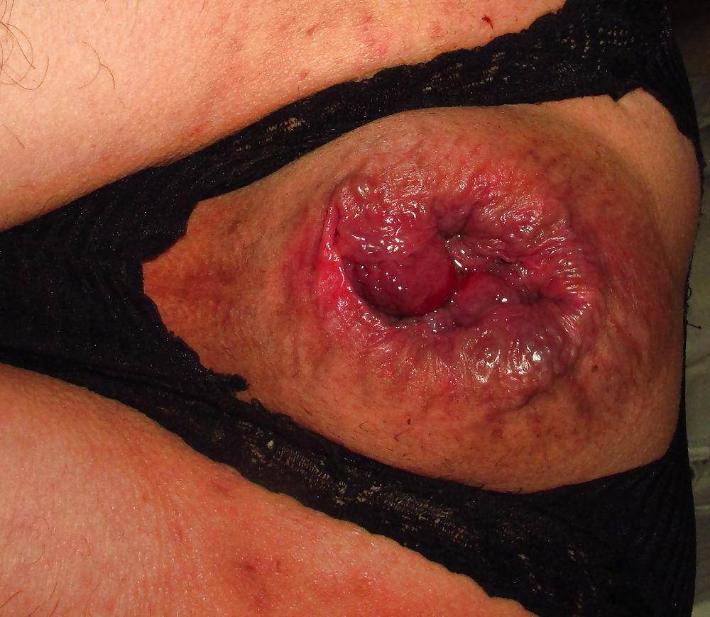 25P Extreme prolapse gape asshole by Marques