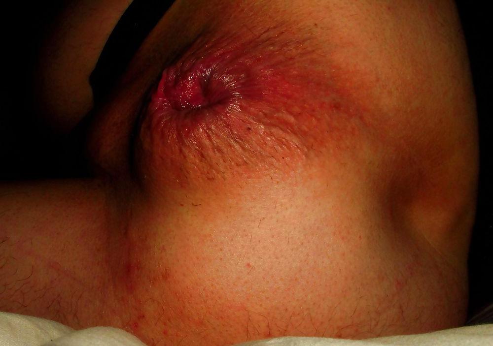 25P Extreme prolapse gape asshole by Marques