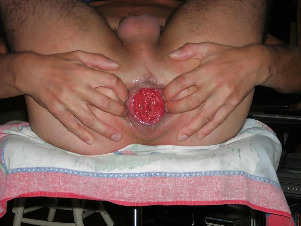 12P Anus bien dilate