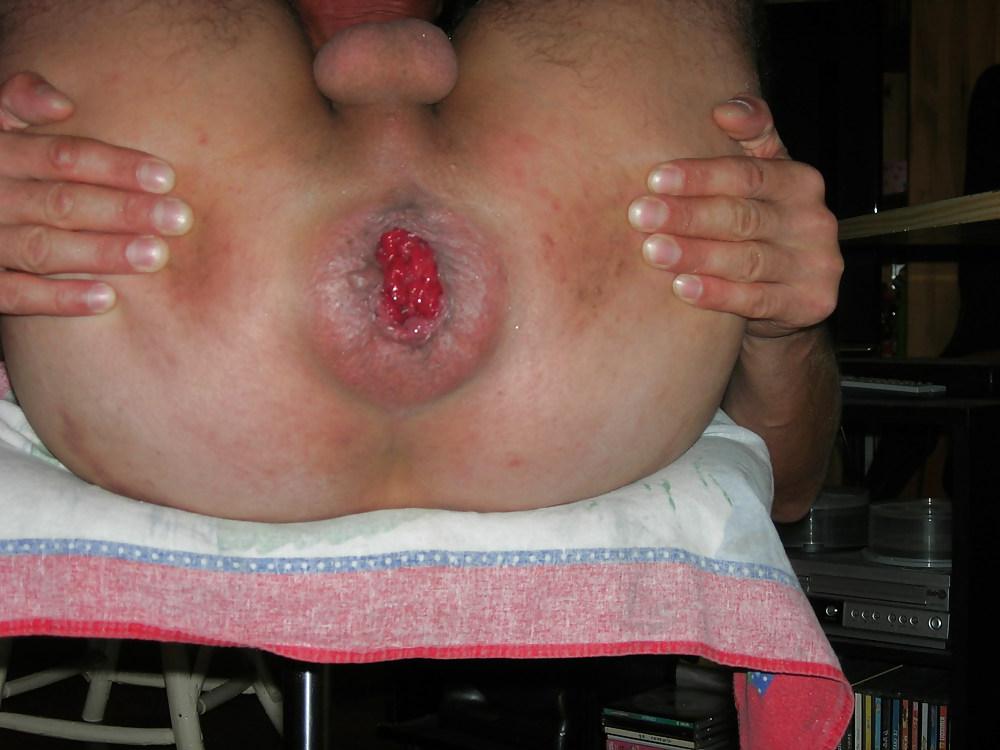 12P Anus bien dilate