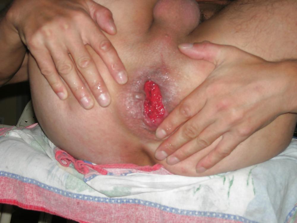 12P Anus bien dilate