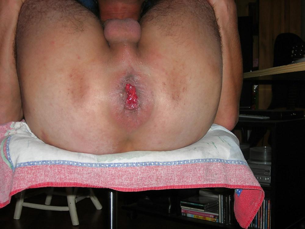 12P Anus bien dilate
