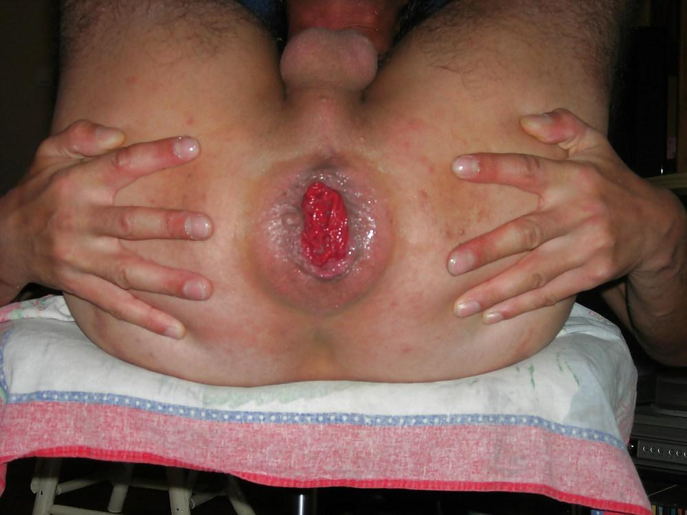 12P Anus bien dilate