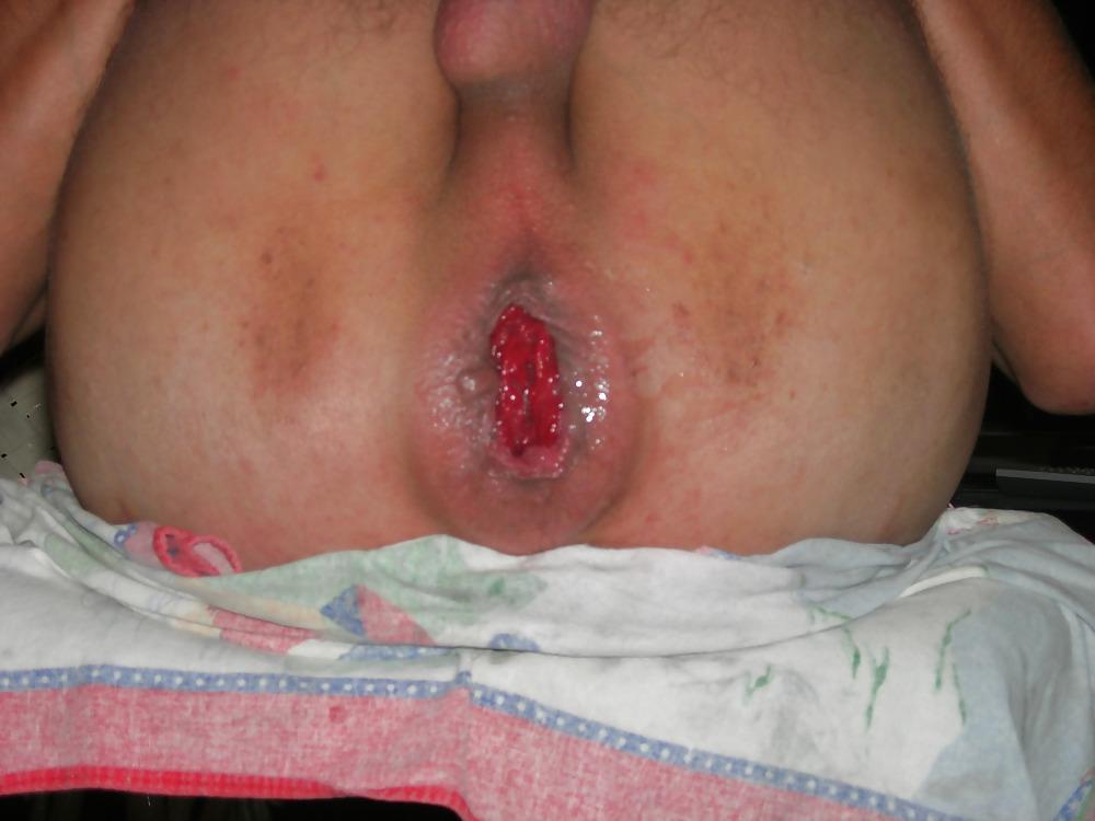 12P Anus bien dilate