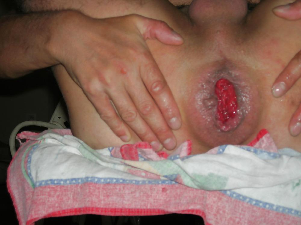 12P Anus bien dilate