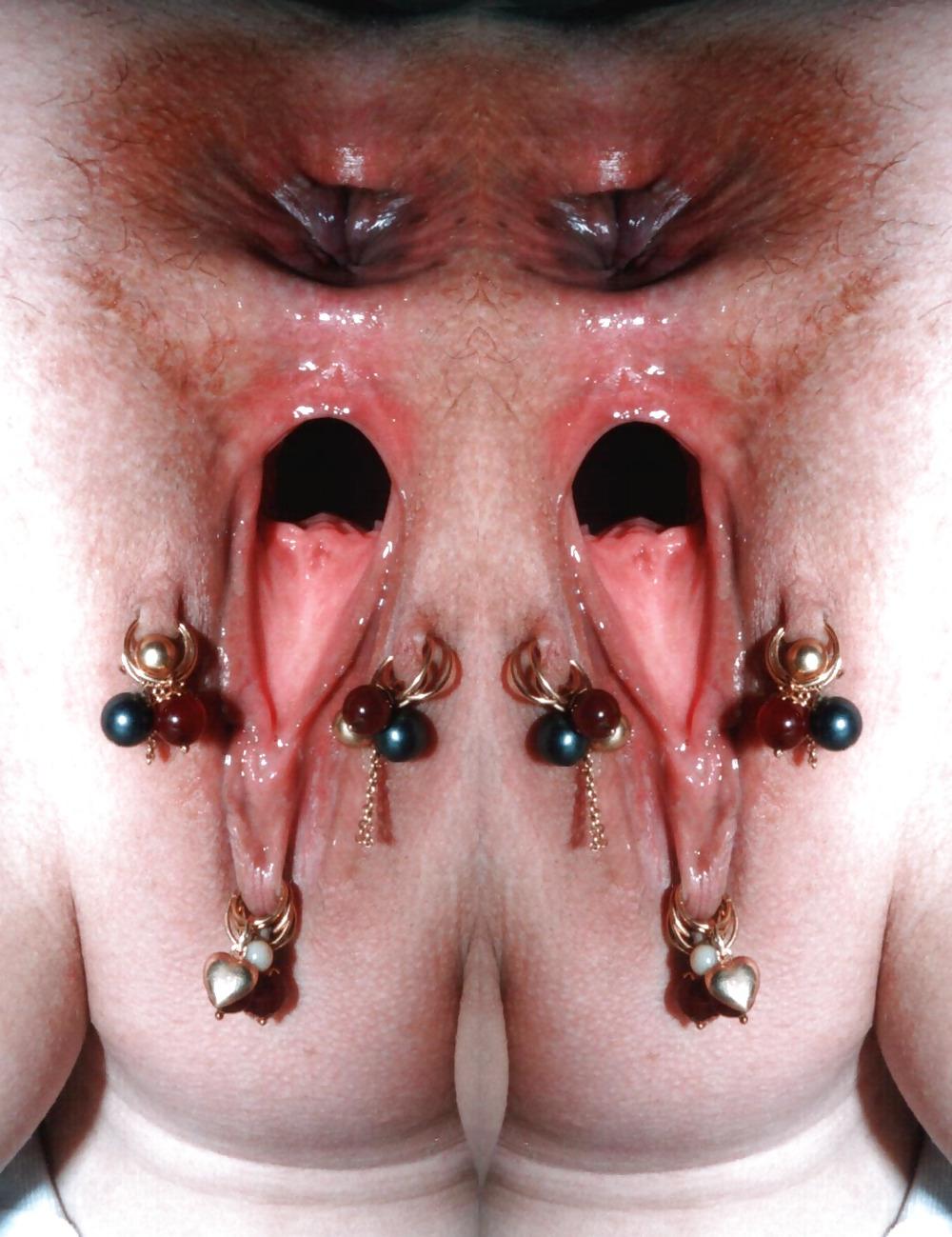 15P ANUS SAILLANT