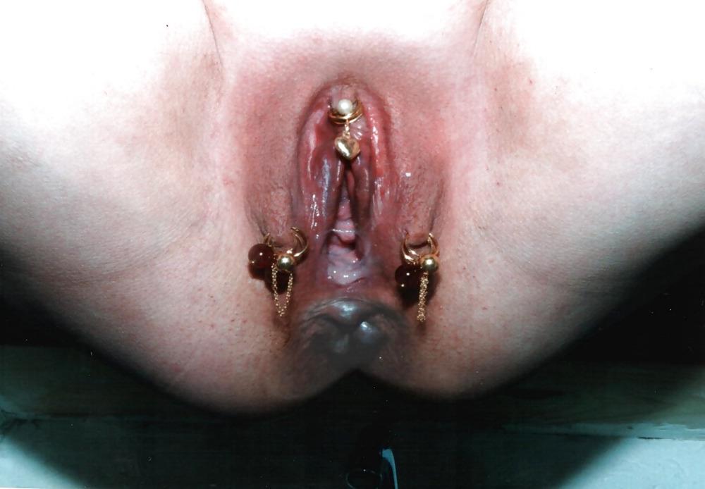 15P ANUS SAILLANT