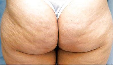 25P Thick, White, and Cellulite 50