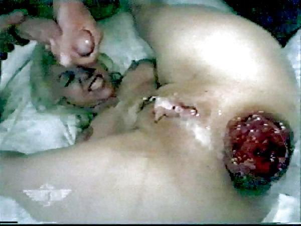 14P Prolapse power