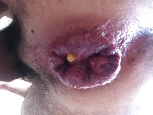 4P Prolapse 2013