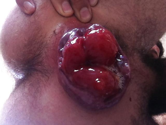 4P Prolapse 2013