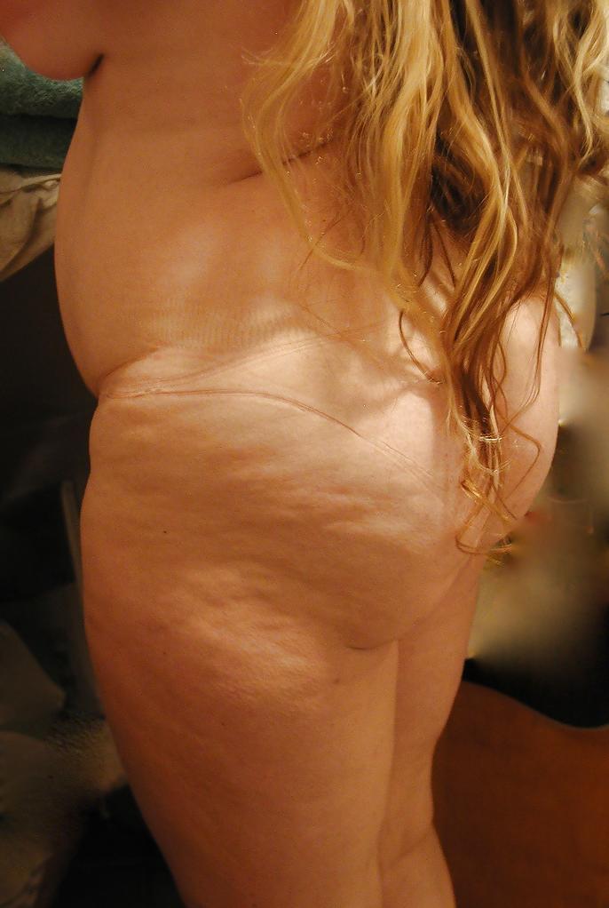 25P Thick, White and Cellulite 121