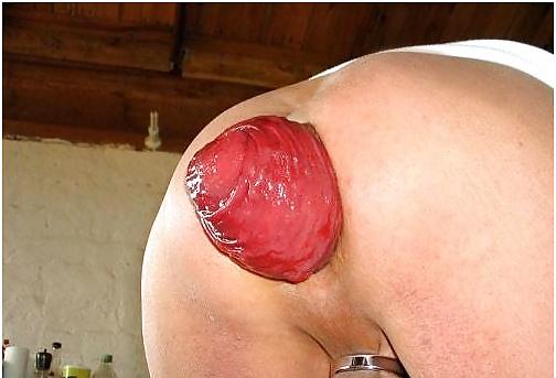 4P Enormous prolapse