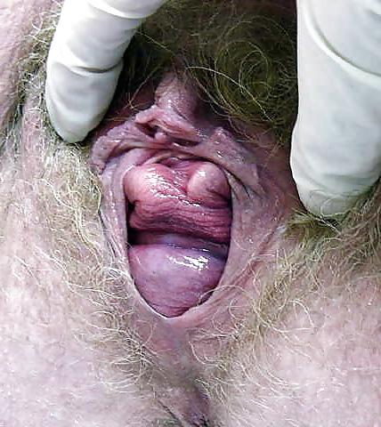 12P Prolapse in elderly ladies is lickable and suckable part 2