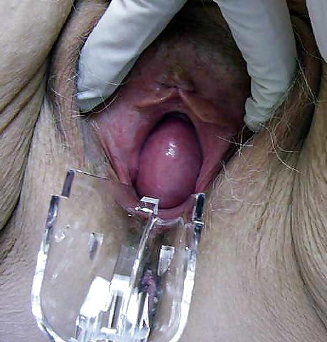 12P Prolapse in elderly ladies is lickable and suckable part 2