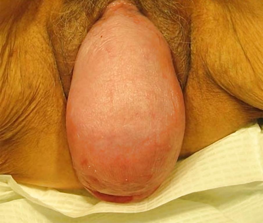 12P Prolapse in elderly ladies is lickable and suckable part 2