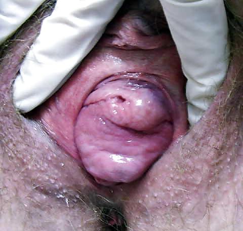 12P Prolapse in elderly ladies is lickable and suckable part 2