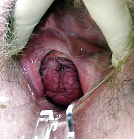 12P Prolapse in elderly ladies is lickable and suckable part 2