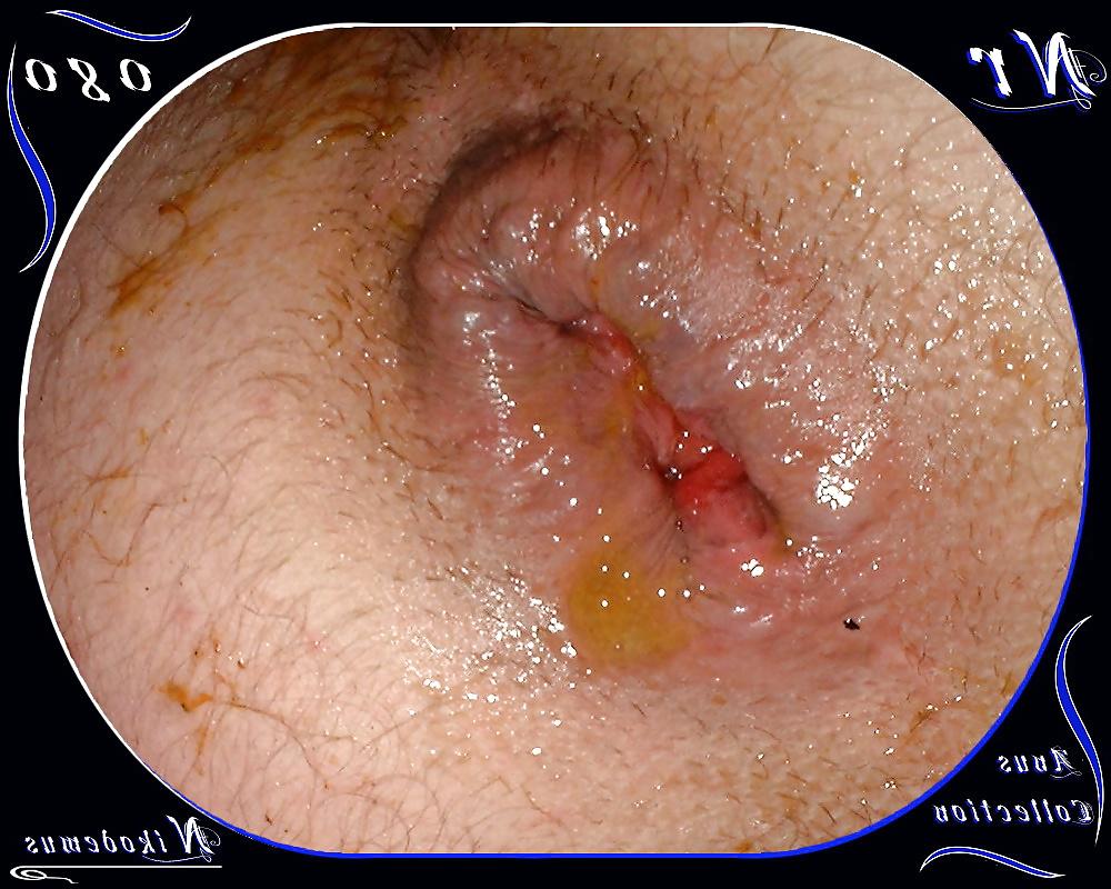 25P Anus Collection