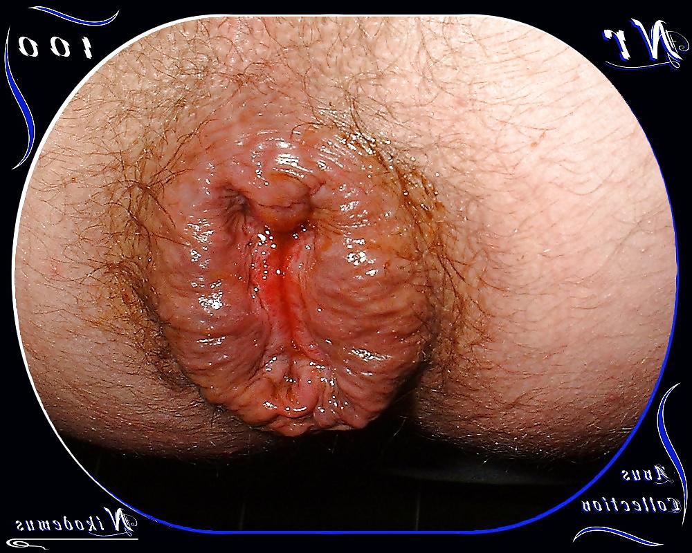 25P Anus Collection