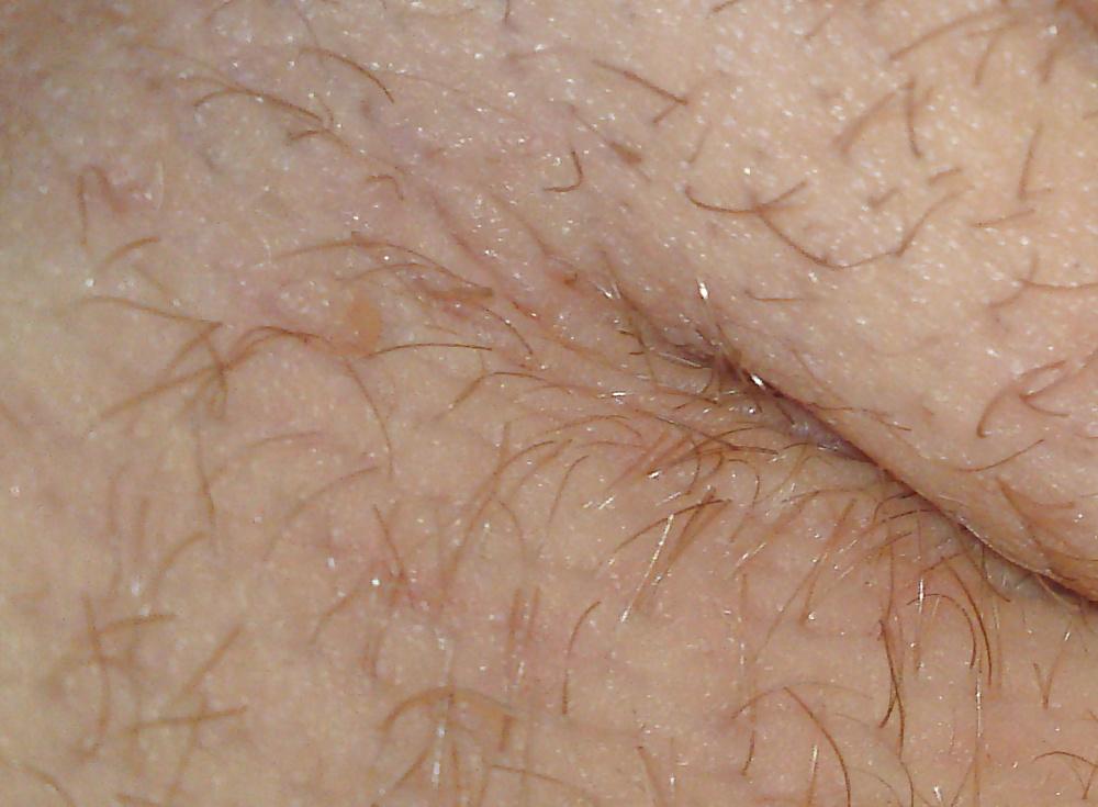 25P HD Armpit