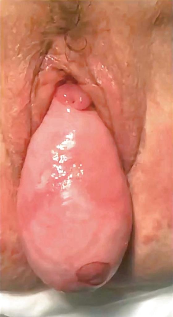 25P Prolapse in elderly ladies is lickable and suckable part 4