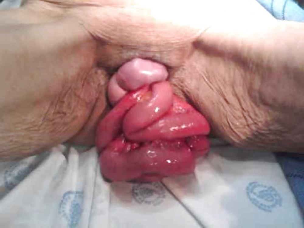 25P Prolapse in elderly ladies is lickable and suckable part 4