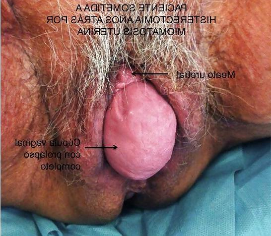 23P Prolapse in elderly ladies is lickable and suckable 3