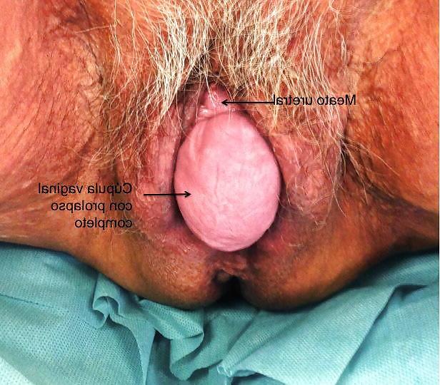 23P Prolapse in elderly ladies is lickable and suckable 3