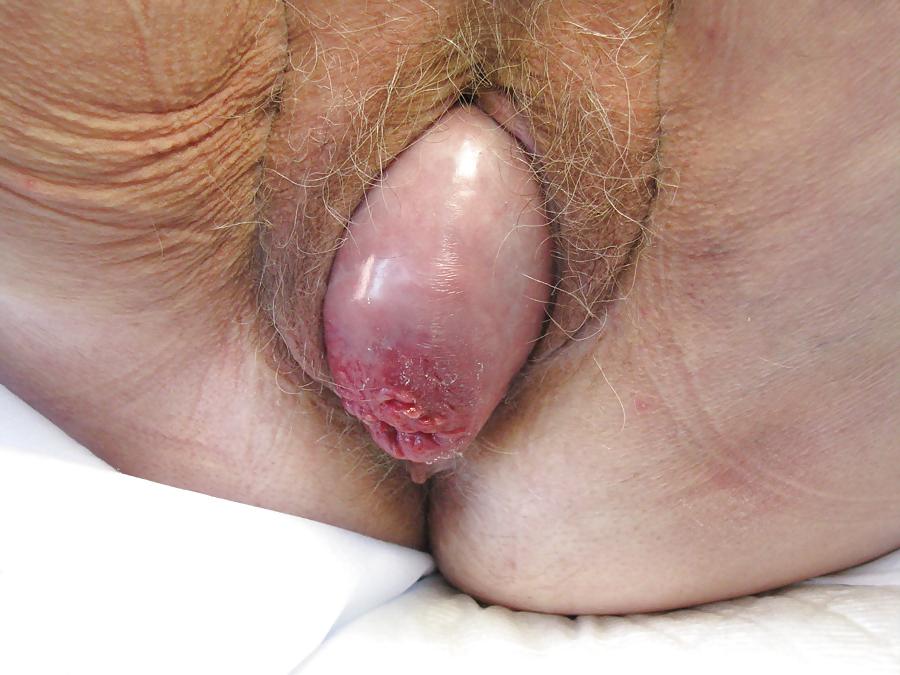 23P Prolapse in elderly ladies is lickable and suckable 3