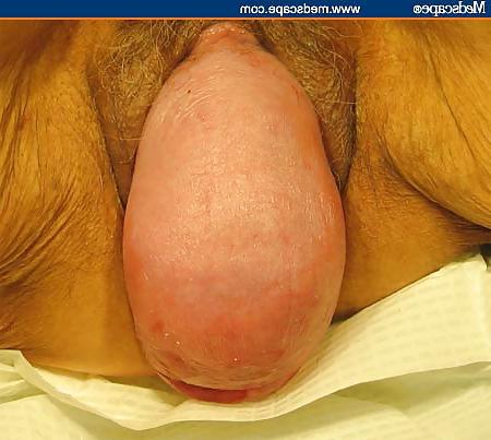 23P Prolapse in elderly ladies is lickable and suckable 3