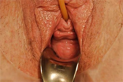 23P Prolapse in elderly ladies is lickable and suckable 3
